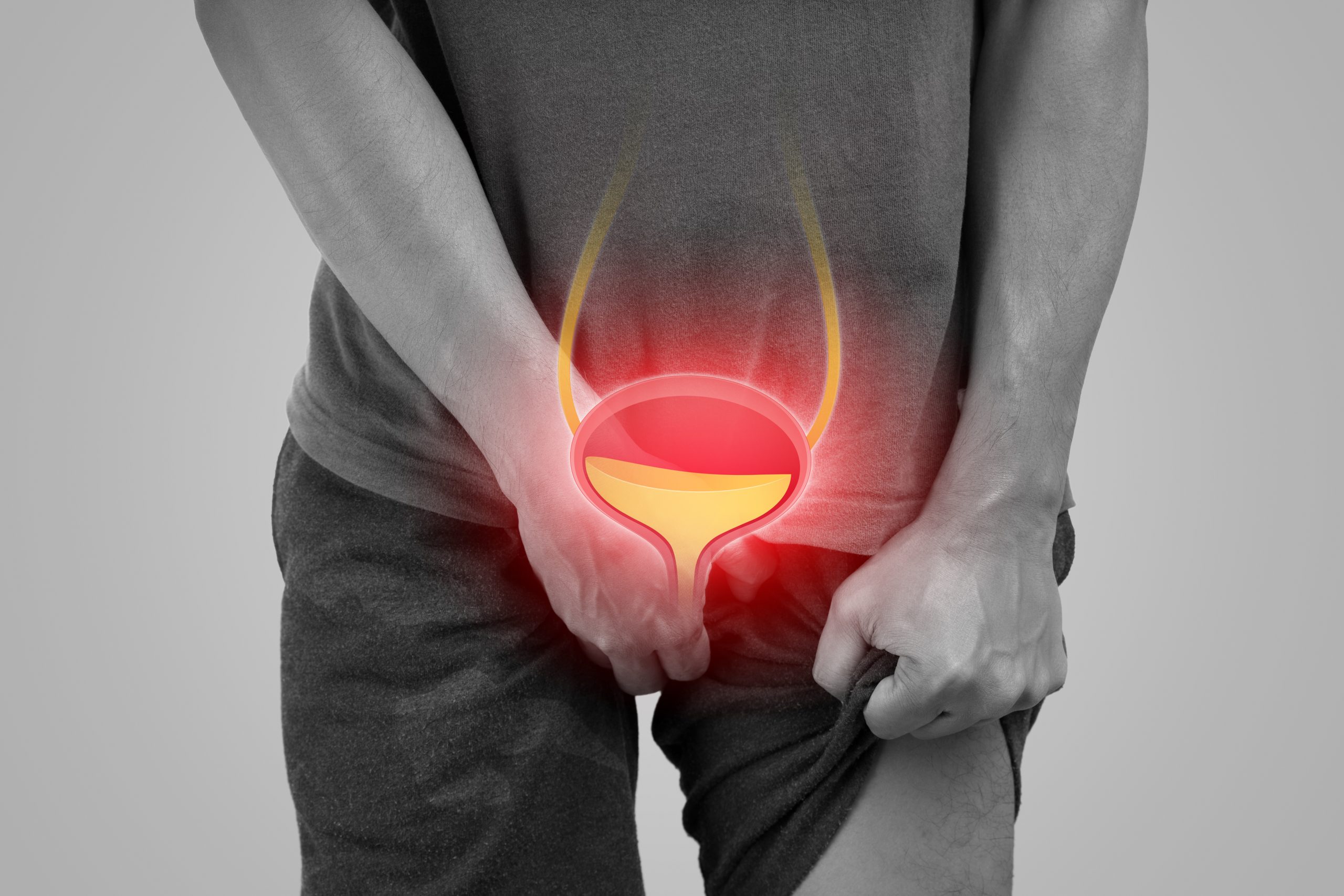 Urinary hesitancy symptoms.